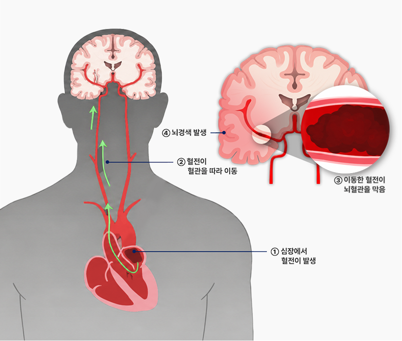 부정맥유형